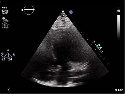 The role of innovative modeling and imaging techniques in improving outcomes in patients with LVAD